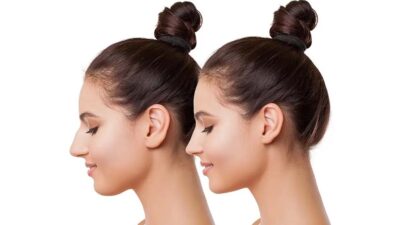 Rinoplastinin hem fiziksel sağlığı hem de yaşam kalitesini iyileştiren kapsamlı