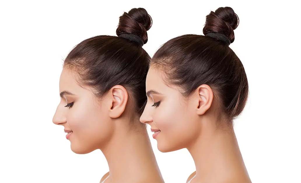 Rinoplastinin hem fiziksel sağlığı hem de yaşam kalitesini iyileştiren kapsamlı