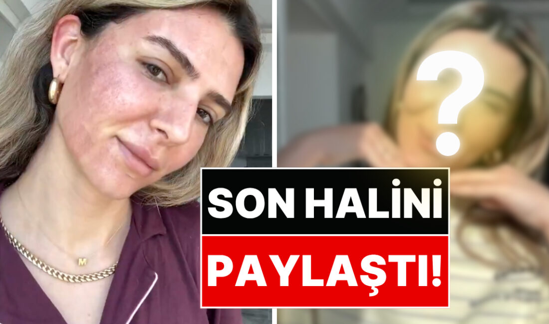 Merve Aydın, yüzüne yaptırdığı fraksiyonel lazer işlemi sonrası son halini