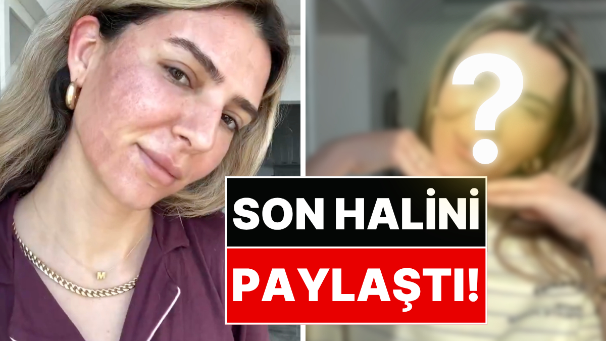 Merve Aydın, yüzüne yaptırdığı fraksiyonel lazer işlemi sonrası son halini